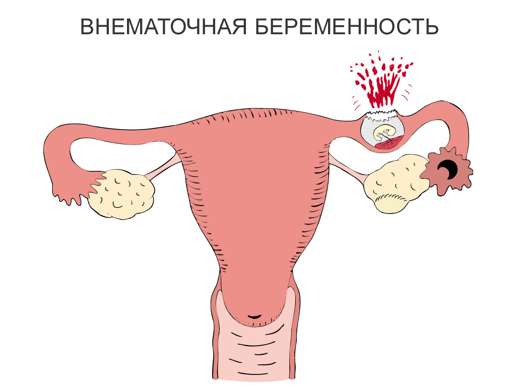 на фото изображен разрыв фаллопиевой трубы при внематочной беременности